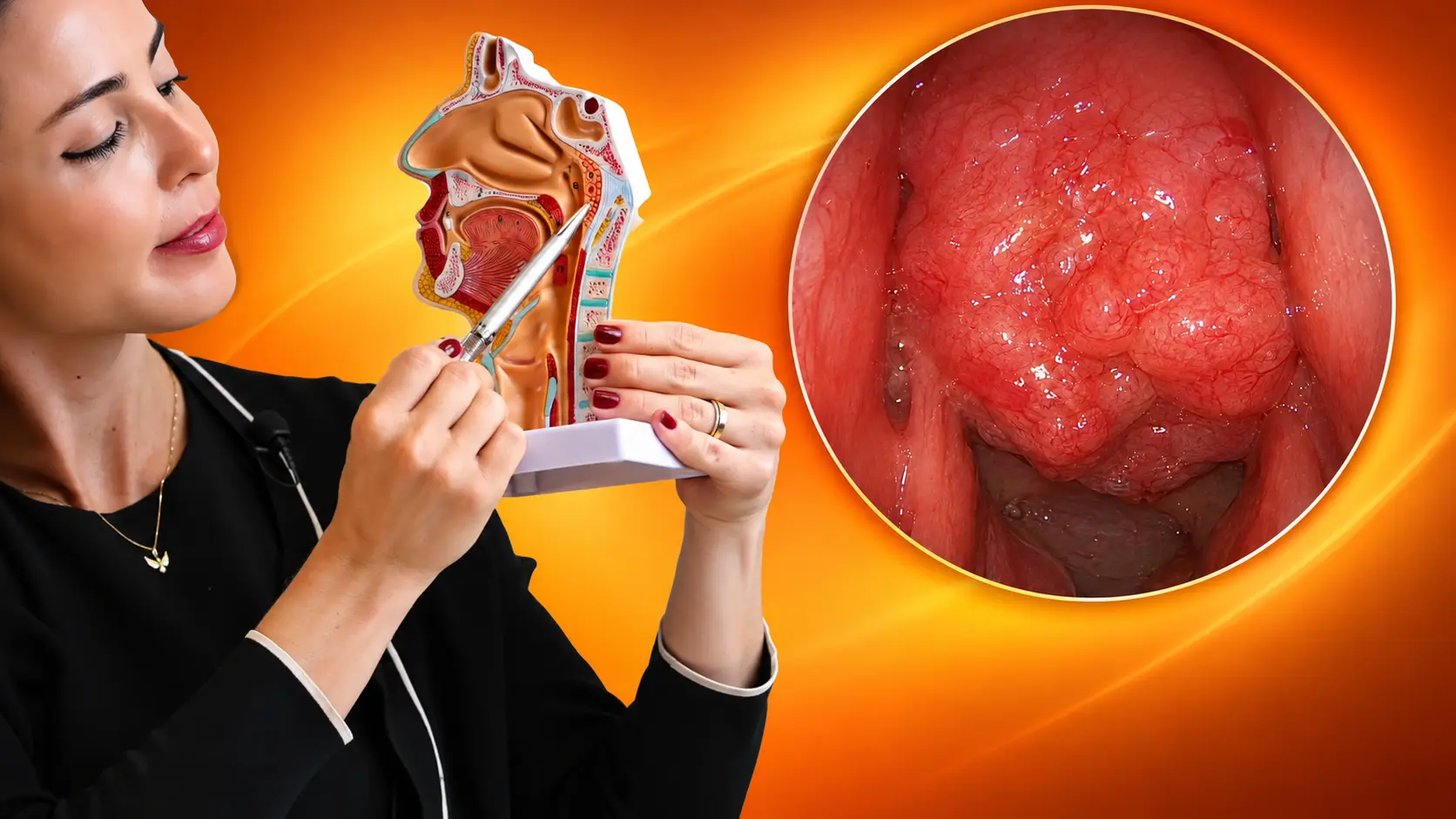 Dra. Larissa Vilela aponta a adenoide em modelo anatômico ao lado de imagem endoscópica do tecido aumentado