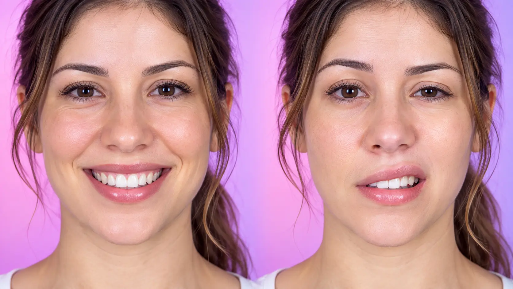 Mulher sorrindo com o rosto simétrico e, ao lado, a mesma mulher com o sorriso torto, sinal de paralisia facial